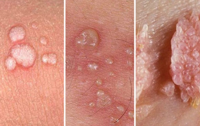 HPV siğil genitalde resimleri - Photos of genital HPV warts