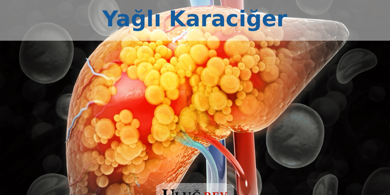 Yağlı Karaciğer: Nedenleri, Belirtileri ve Tedavisi