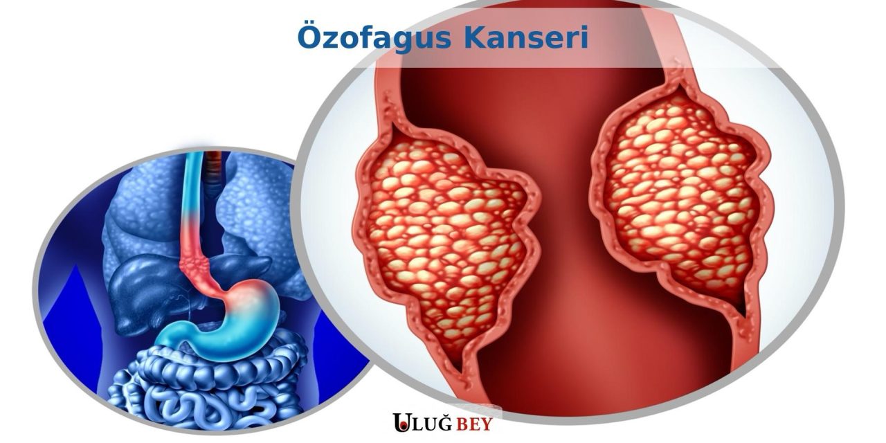 Özofagus Kanseri: Nedenleri, Tanı ve Tedavi